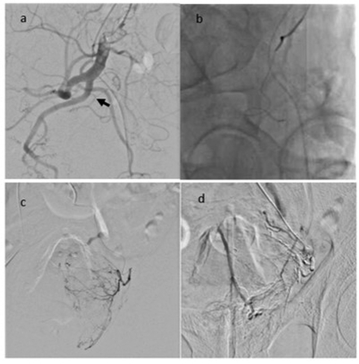 Robotic-assisted simple prostatectomy after prostatic arterial embolization for large benign prostate hyperplasia: Initial experience