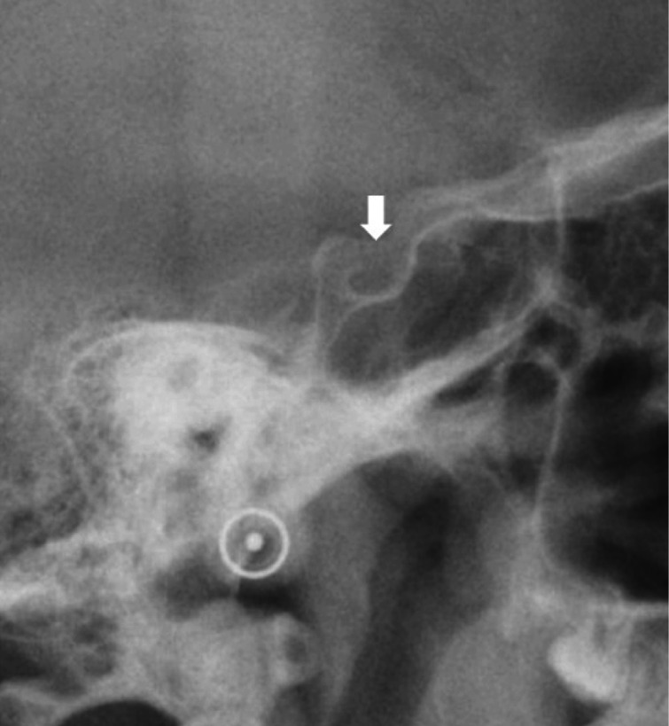 A retrospective study of incidental findings occurring in a consecutive case series of lateral cephalograms of 12- to 20-year-old patients referred for routine orthodontic treatment.