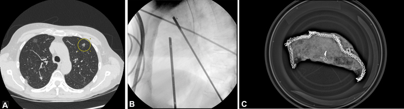 A Simple Method to Improve Intraoperative Localization of Fiducial Markers during Lung Resections.