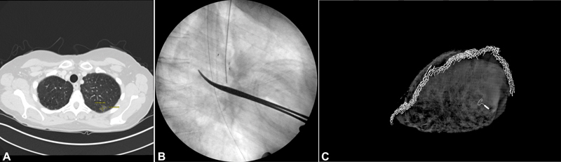 A Simple Method to Improve Intraoperative Localization of Fiducial Markers during Lung Resections.