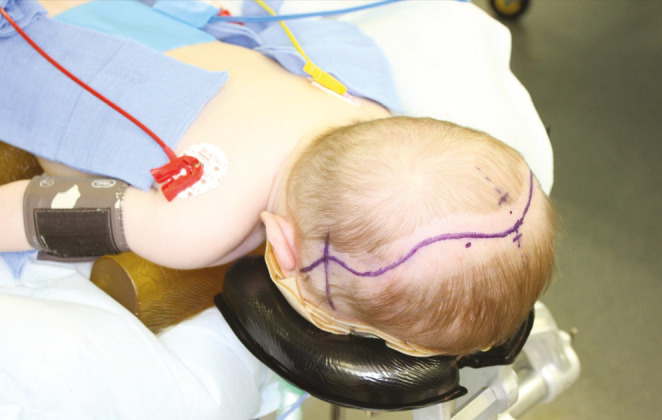 Management of Chiari 1 Malformation and Hydrocephalus in Syndromic Craniosynostosis: A Review.