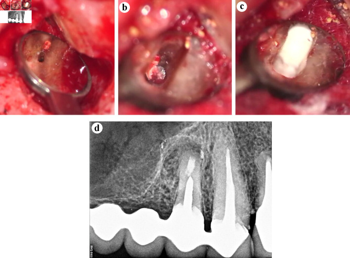 Resolution of Odontogenic Sinus Pathosis by Endodontic Microsurgery.