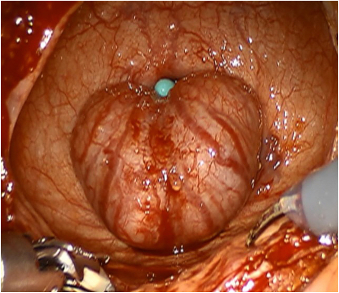 Robotic-assisted simple prostatectomy after prostatic arterial embolization for large benign prostate hyperplasia: Initial experience