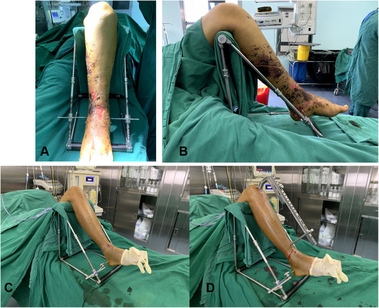 Use of a Minimally Invasive Traction Repositor versus Conventional Manual Traction for the Treatment of Tibial Fractures: A Comparative Study from a Tertiary Hospital in China.