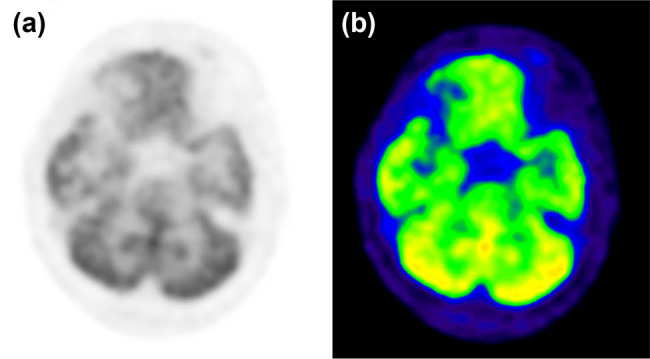 A rare brainstem anaplastic astrocytoma.