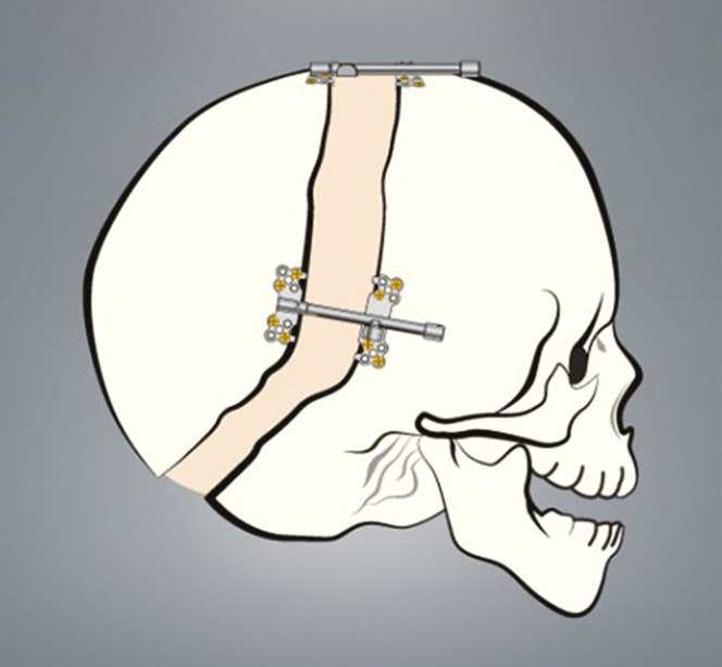 Management of Chiari 1 Malformation and Hydrocephalus in Syndromic Craniosynostosis: A Review.