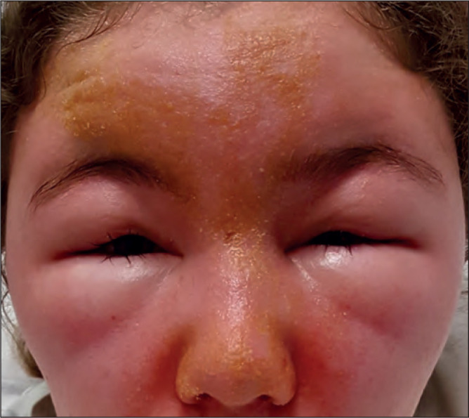 ALLERGIC CONTACT DERMATITIS TO A COMMON TOPICAL ACNE TREATMENT - AN UNFAMILIAR MIMIC OF ANGIOEDEMA.