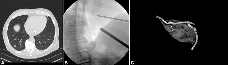 A Simple Method to Improve Intraoperative Localization of Fiducial Markers during Lung Resections.