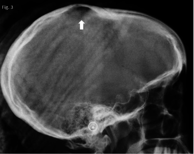 A retrospective study of incidental findings occurring in a consecutive case series of lateral cephalograms of 12- to 20-year-old patients referred for routine orthodontic treatment.