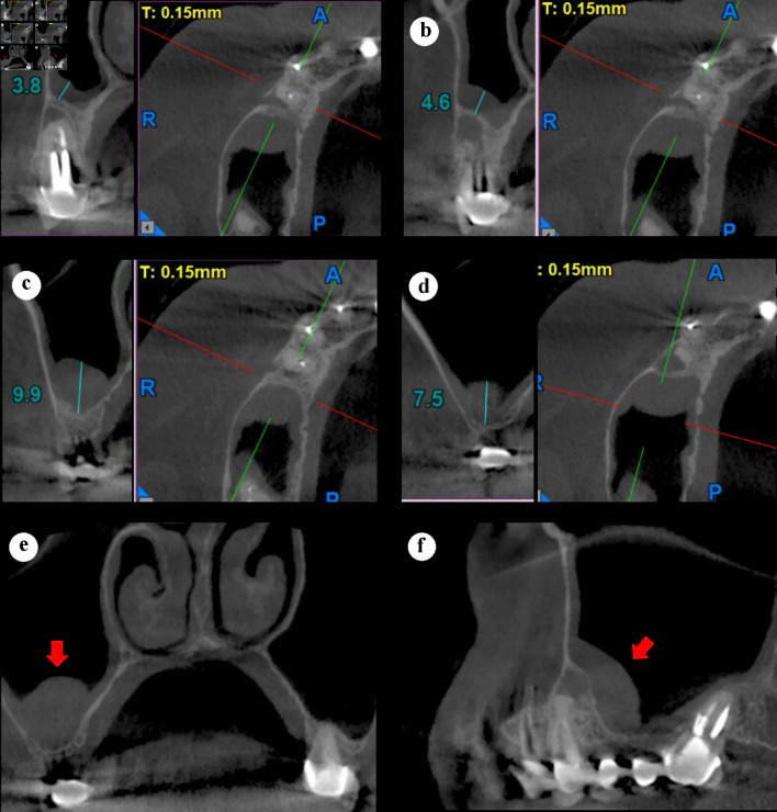 Resolution of Odontogenic Sinus Pathosis by Endodontic Microsurgery.