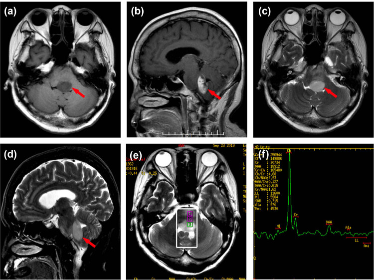 A rare brainstem anaplastic astrocytoma.