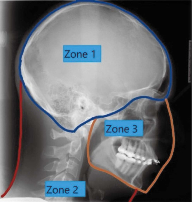 A retrospective study of incidental findings occurring in a consecutive case series of lateral cephalograms of 12- to 20-year-old patients referred for routine orthodontic treatment.