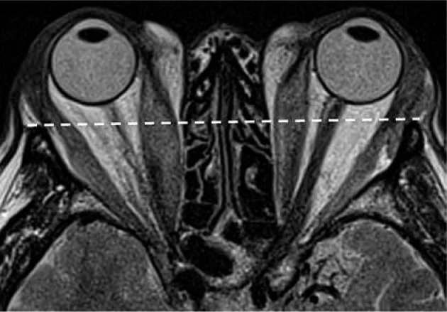 Validation of exophthalmos magnetic resonance imaging measurements in patients with Graves' orbitopathy, compared to ophthalmometry results.