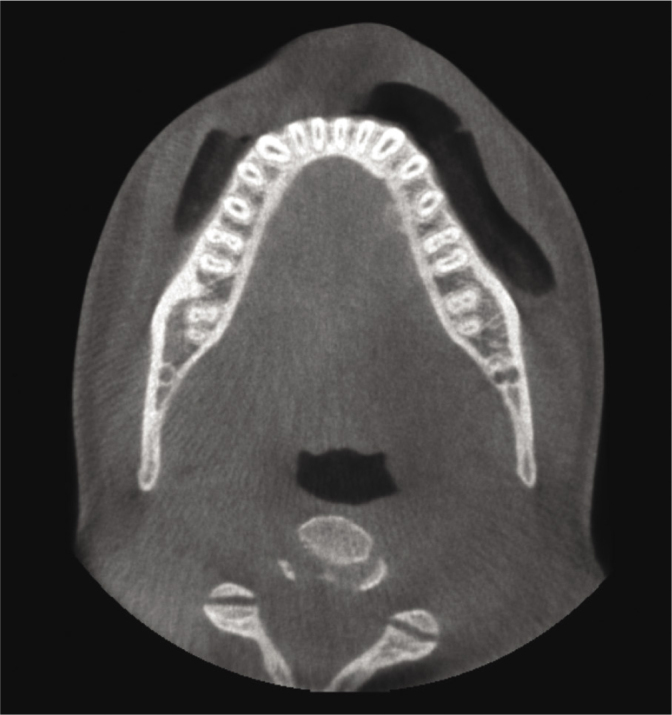 Ultrasonographic Diagnosis of Osteochondroma of the Mandible: A Case Report.