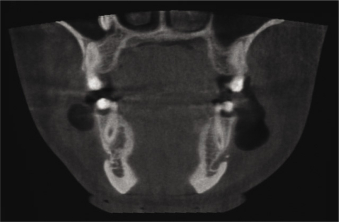 Ultrasonographic Diagnosis of Osteochondroma of the Mandible: A Case Report.