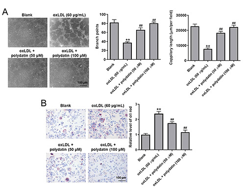 Polydatin reverses oxidation low lipoprotein (oxLDL)-induced apoptosis of human umbilical vein endothelial cells <em>via</em> regulating the miR-26a-5p/BID axis.