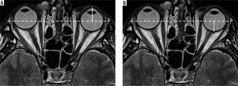 Validation of exophthalmos magnetic resonance imaging measurements in patients with Graves' orbitopathy, compared to ophthalmometry results.