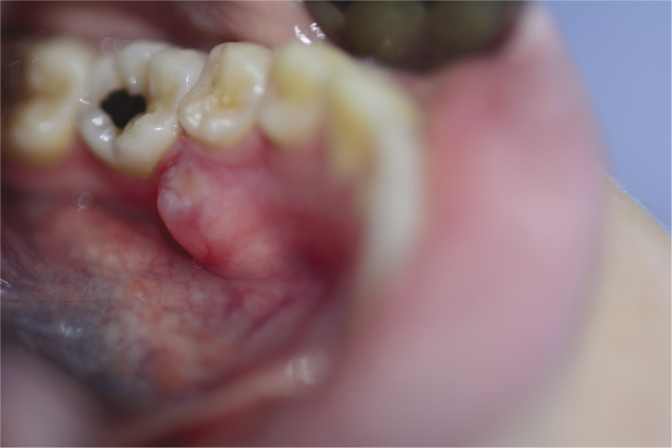 Ultrasonographic Diagnosis of Osteochondroma of the Mandible: A Case Report.