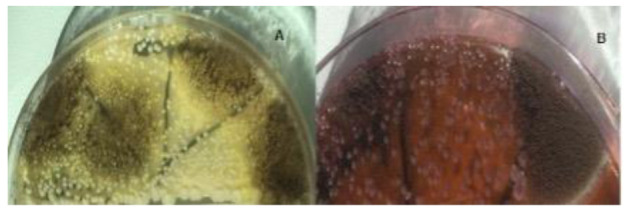 A rare case of a nasal cavity fungus ball due to <i>Aspergillus niger</i>.