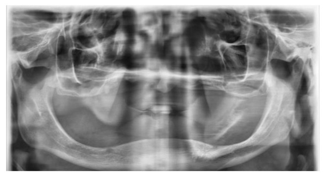 A rare case of a nasal cavity fungus ball due to <i>Aspergillus niger</i>.