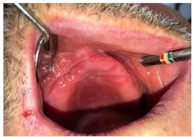 A rare case of a nasal cavity fungus ball due to <i>Aspergillus niger</i>.