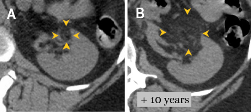 Exceptional Extension of Benign Angiomyolipoma in the Renal Vein.