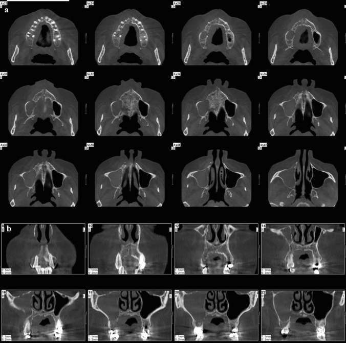 Post-COVID mucormycosis osteomyelitis and its imaging manifestations in the North of Iran: case series.