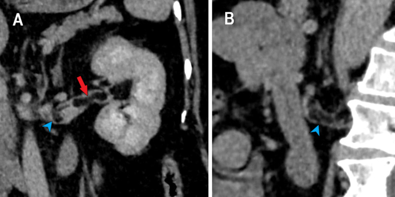 Exceptional Extension of Benign Angiomyolipoma in the Renal Vein.