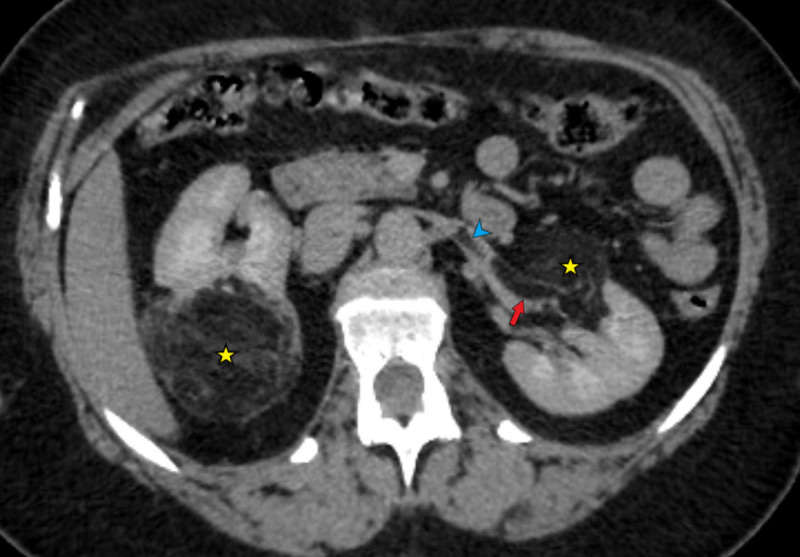 Exceptional Extension of Benign Angiomyolipoma in the Renal Vein.