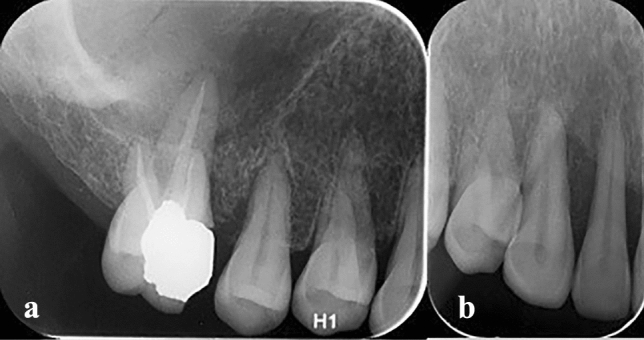 Post-COVID mucormycosis osteomyelitis and its imaging manifestations in the North of Iran: case series.