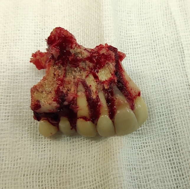 Post-COVID mucormycosis osteomyelitis and its imaging manifestations in the North of Iran: case series.