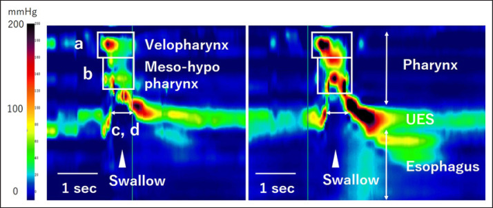 The Usefulness of Swallowing Pressure Assessment in the Identification of Mild Pharyngeal Weakness of Myasthenia Gravis: A Case Report.