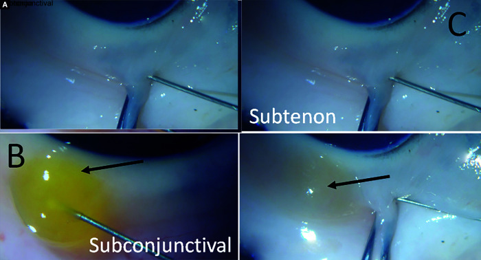 Bleb-related Porcine Lymphatic Outflow is Greater from Subconjunctival compared to Subtenon Blebs.