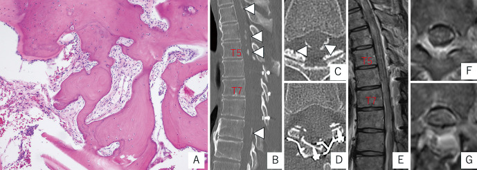 Diagnosis and Treatment Strategies for Arachnoiditis Ossificans Following Subarachnoid Hemorrhage: A Case Report.