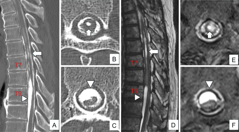 Diagnosis and Treatment Strategies for Arachnoiditis Ossificans Following Subarachnoid Hemorrhage: A Case Report.