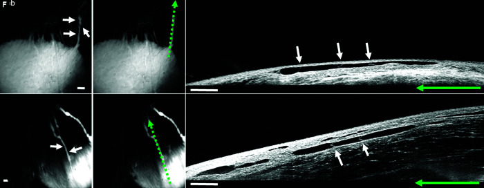 Bleb-related Porcine Lymphatic Outflow is Greater from Subconjunctival compared to Subtenon Blebs.