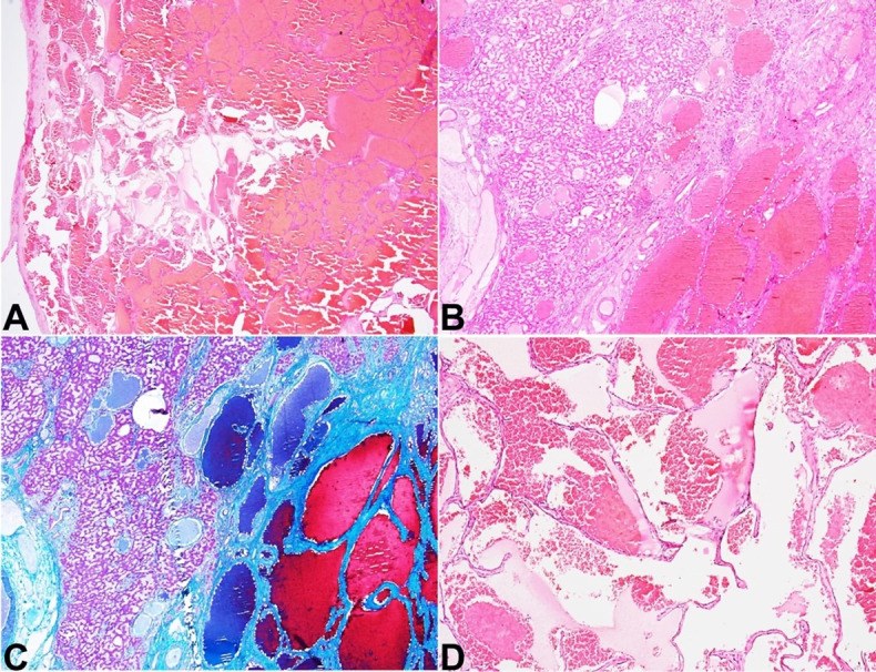 Adult diffuse hepatic hemangiomatosis.