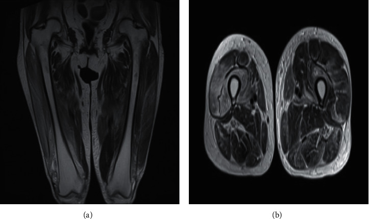 Nephrotic Syndrome as an Extramuscular Manifestation of Anti-EJ Antibody-Positive Dermatomyositis: A Case Report and Review of the Literature.