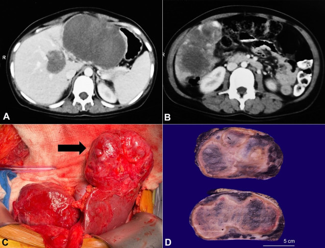 Adult diffuse hepatic hemangiomatosis.