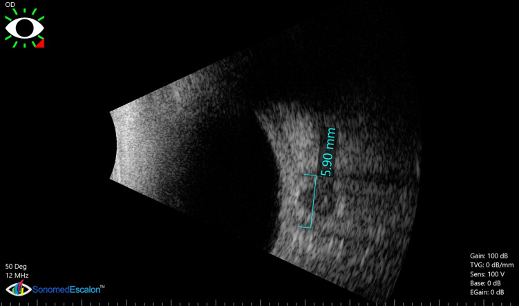 Value of Optic Nerve Sheath Diameter in Diagnosis and Follow Up of Patients with Disturbed Conscious Level.