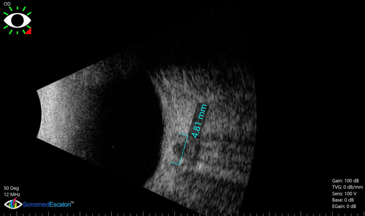 Value of Optic Nerve Sheath Diameter in Diagnosis and Follow Up of Patients with Disturbed Conscious Level.