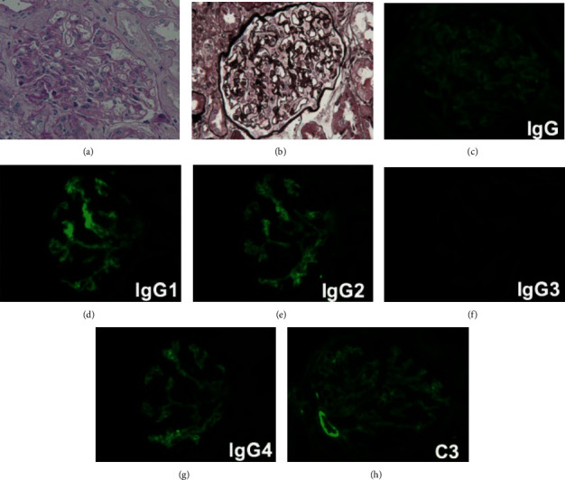 Nephrotic Syndrome as an Extramuscular Manifestation of Anti-EJ Antibody-Positive Dermatomyositis: A Case Report and Review of the Literature.