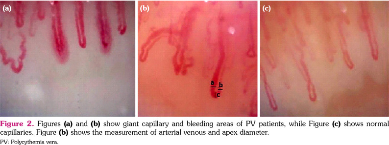 Use of nailfold video capillaroscopy in polycythemia vera.