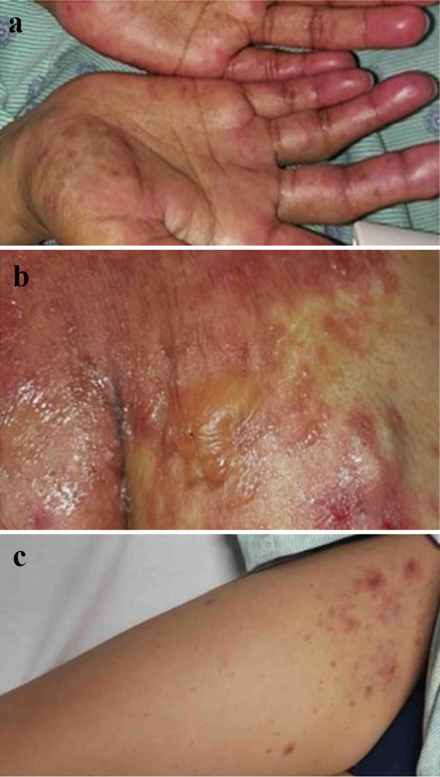 Steven-Johnson Syndrome: A Rare but Serious Adverse Event of Nivolumab Use in a Patient With Metastatic Gastric Adenocarcinoma.