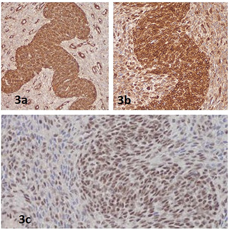 Advanced-stage Endometrial Stromal Sarcoma Presenting as Primary Infertility in a Young Nulligravida: A Case Report.