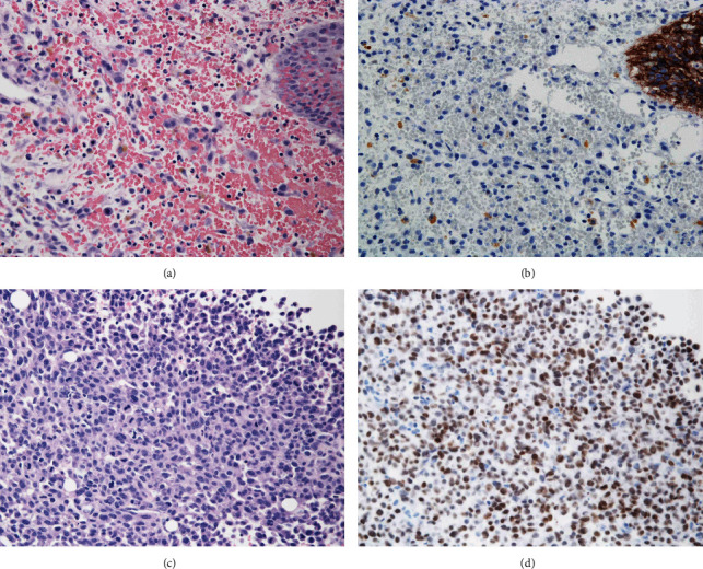 Plasmacytoid Urothelial Carcinoma of the Bladder That Manifests Disseminated Carcinomatosis of the Bone Marrow: A Case Report of Extremely Rapid Progression.