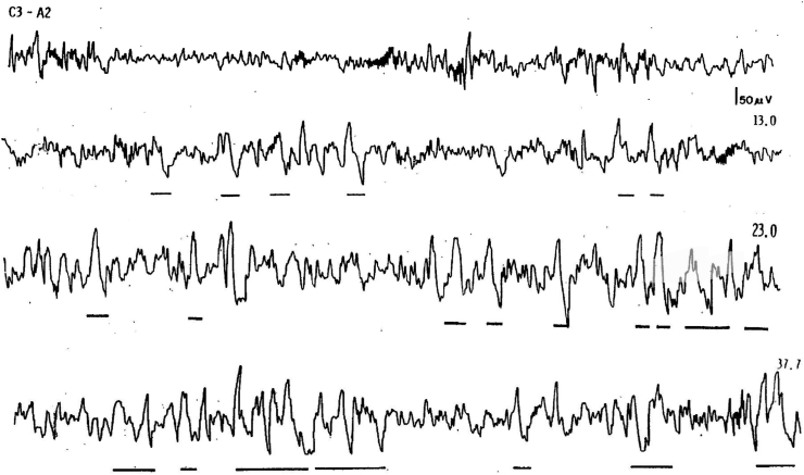 Disorders of Arousal and timing of the first period of slow wave sleep: Clinical and forensic implications