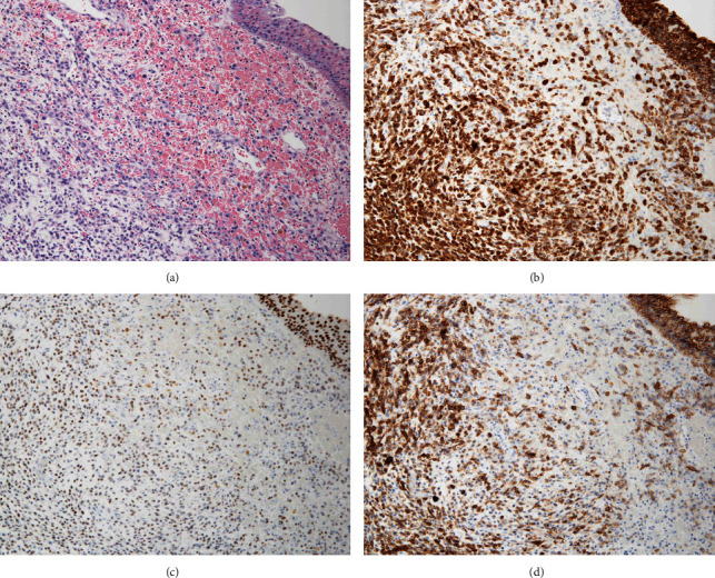 Plasmacytoid Urothelial Carcinoma of the Bladder That Manifests Disseminated Carcinomatosis of the Bone Marrow: A Case Report of Extremely Rapid Progression.