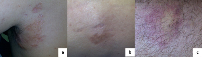 Acute Disseminated Panniculitis Associated with Alpha-1 Antitrypsin Deficiency.