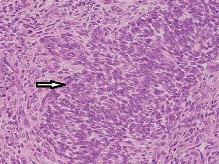 Advanced-stage Endometrial Stromal Sarcoma Presenting as Primary Infertility in a Young Nulligravida: A Case Report.